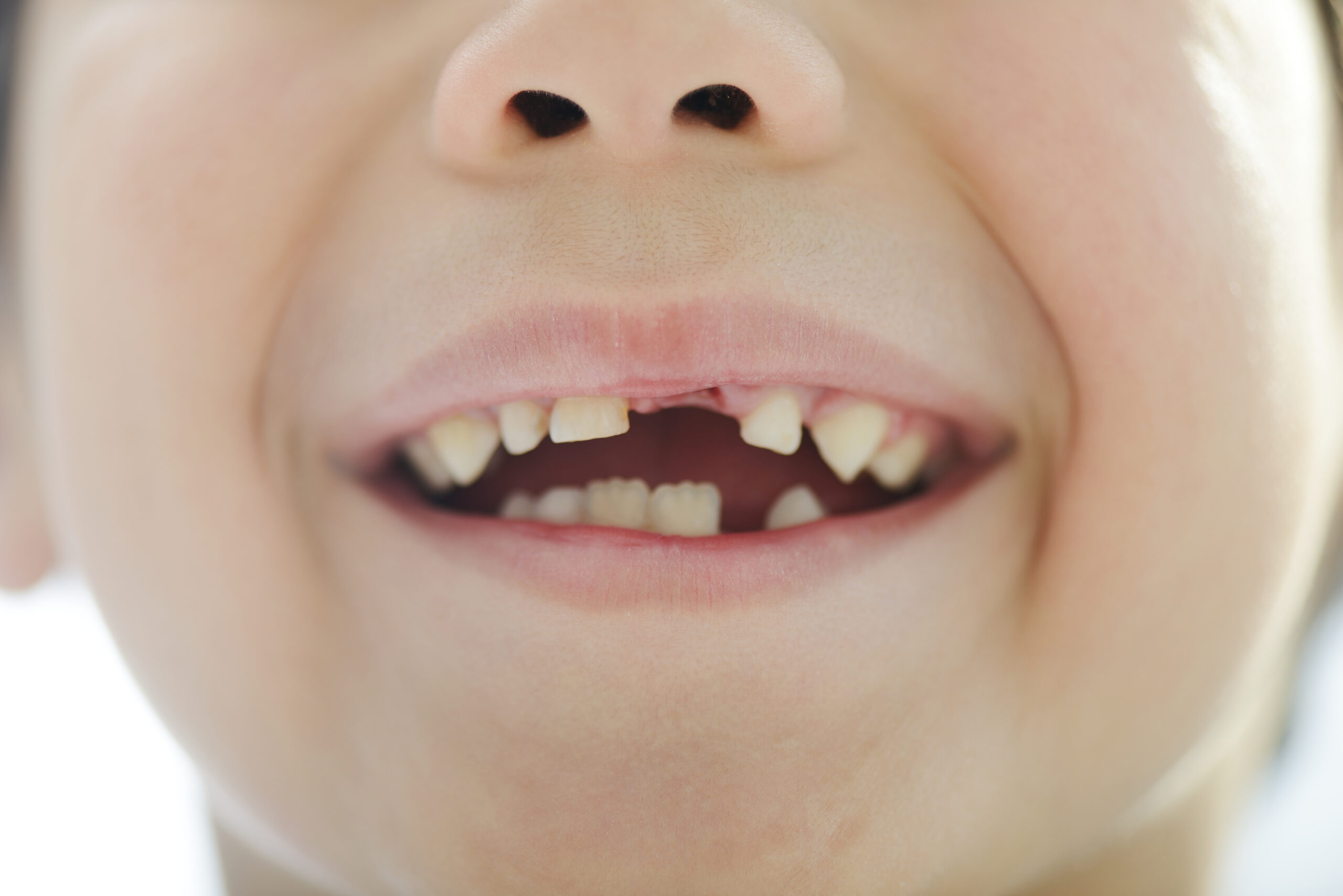 Portrait of cute kid losing his first tooth