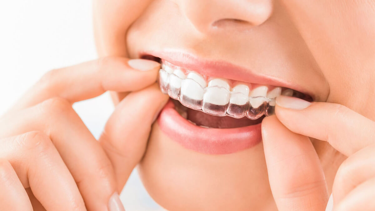 invisalign adalah