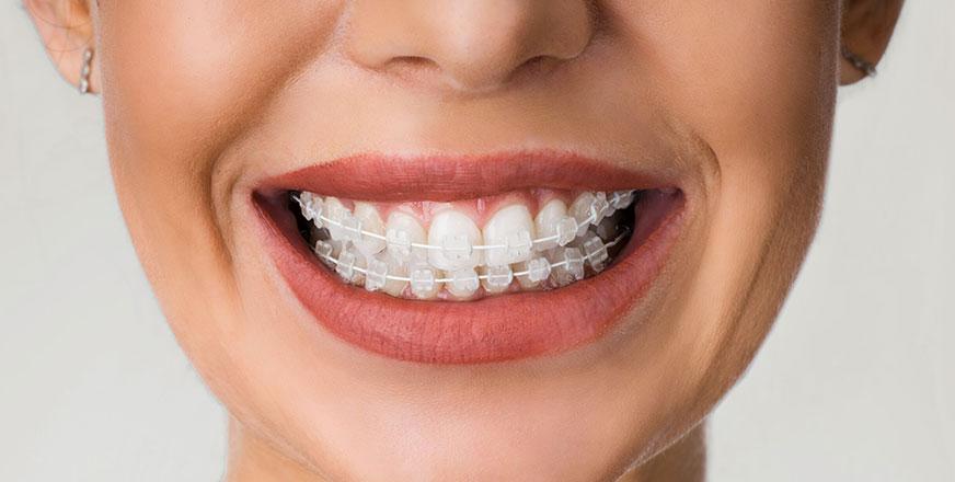 Behel Ceramic: Pengertian, Manfaat, dan Prosedur Pemasangan